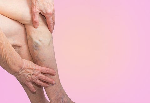 varicose veins legs