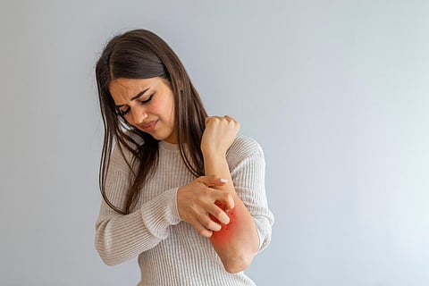 Mujer rascándose una picazón sobre fondo blanco. Piel sensible, Síntomas de alergia alimentaria, Irritación. La gente se rasca la picazón con la mano, el brazo, la picazón, el concepto con la atención médica y la medicina.