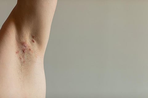 Patients With Hidradenitis Suppurativa Have Increased Risk for Self-Harm