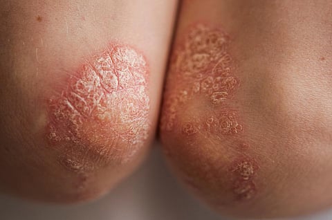Acute psoriasis on the elbows is an autoimmune incurable dermatological skin disease. Large red, inflamed, flaky rash on the elbows. Joints affected by psoriatic arthritis