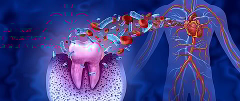 Periodontal Disease, Caries Linked to Risk for Ischemic Stroke, MACE
