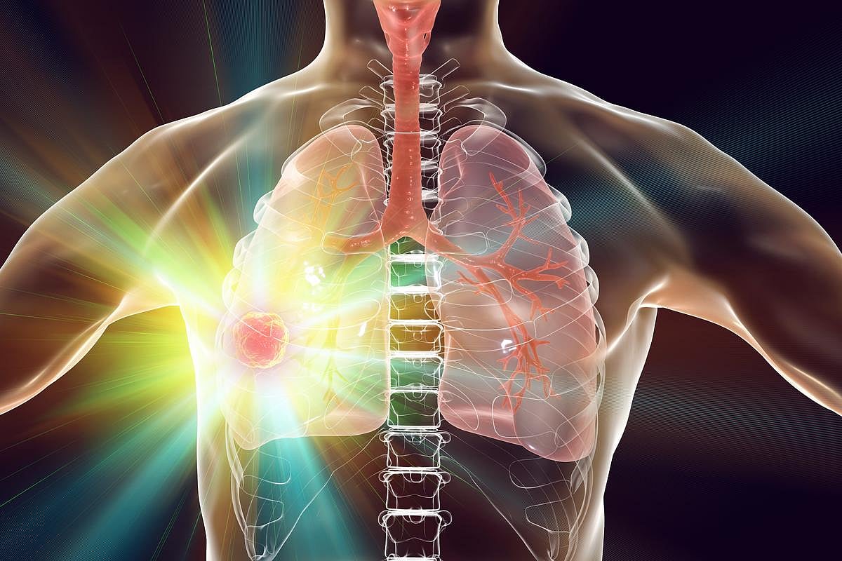 Thymic Radiation Linked to Worse Outcomes in Patients With NSCLC