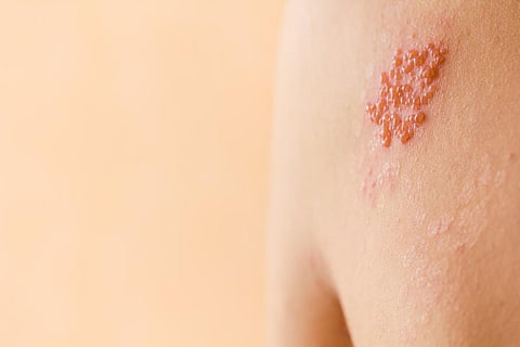 Shingles on men herpes zoster.