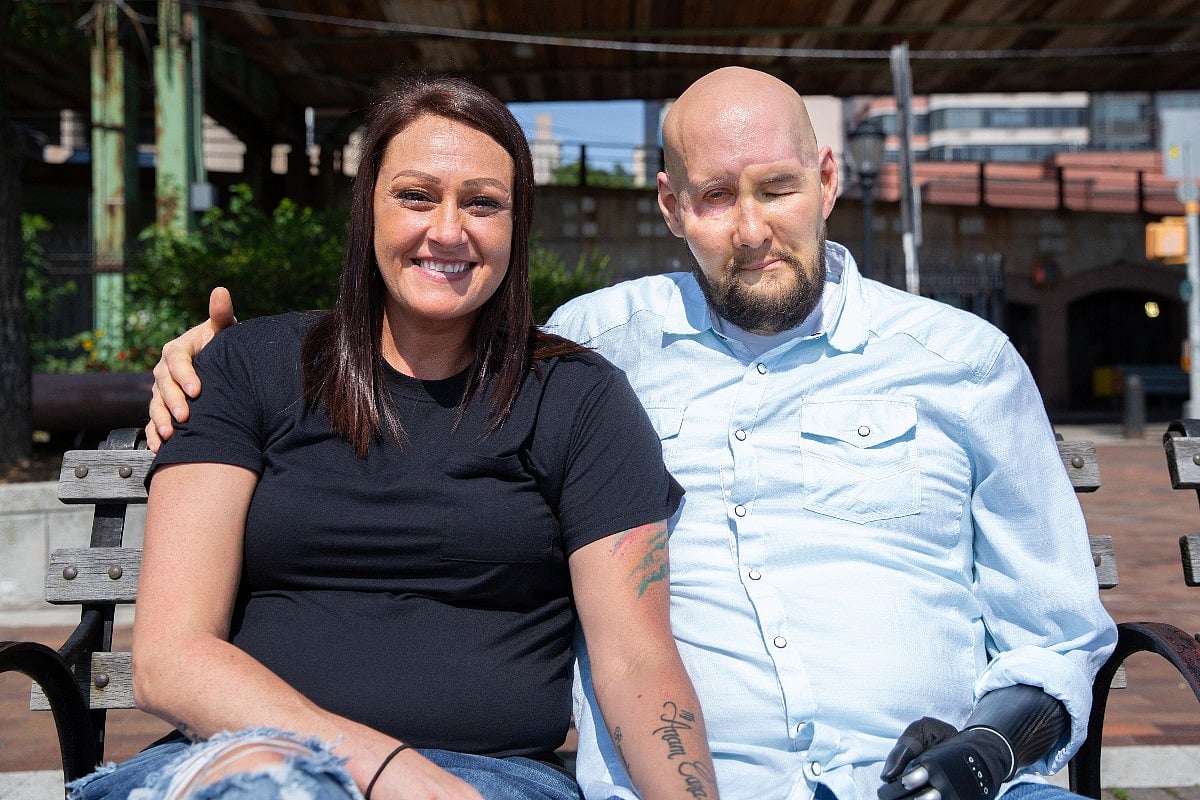 He's Doing Great Year After World's First Eye/Partial Face Transplant