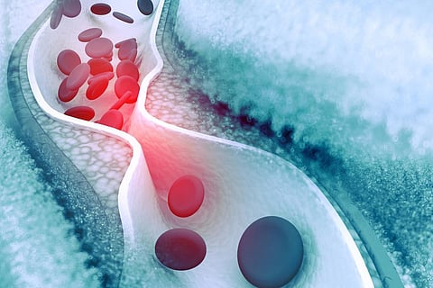 cholesterol plaque in the artery