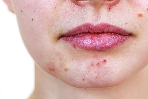 A person with acne