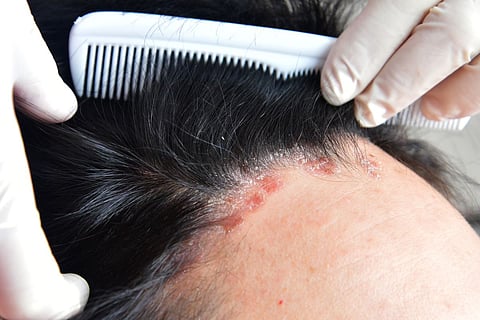 psoriasis scalp