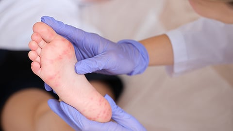 measles