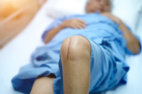 Los cónyuges también se benefician de la artroplastía de rodilla/cadera de su pareja