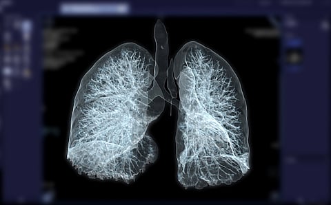 Chest CT Scans Can Help Diagnose Pneumonia