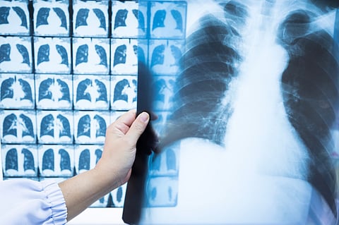 Current USPSTF Screening Guidelines Miss Many Patients With Lung Cancer