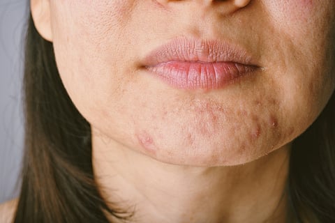 Problema de la piel con enfermedades del acné, primer plano de la cara de la mujer con granos de punto blanco en la barbilla, brote de la menstruación, cicatriz y cara grasosa grasa, concepto de belleza.