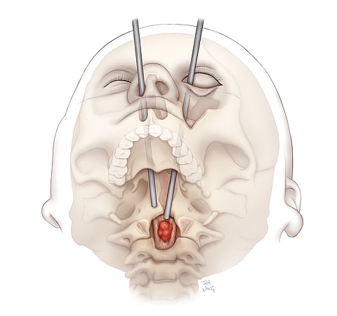 Ilustración de la vía quirúrgica transorbitaria al cordoma espinal