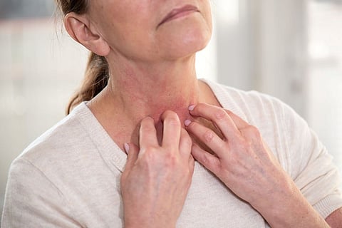 itch dermatitis eczema
