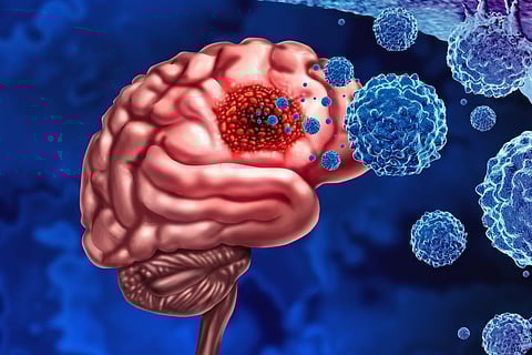 glioma brain cancer tumor