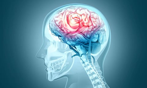 brain bleed hemorrhage