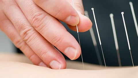 acupuncture
