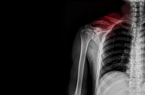 Fracture clavicle.Plain radiograph of human shoulder after accident.The film shown calcific tendinitis of rotator cuff.Patient came to hospital with severe pain.Medical concept.Motor vehicle accident.