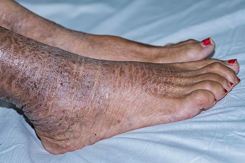 ichthyosis