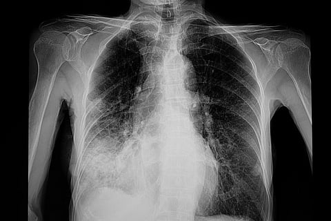 Radiografía de tórax del paciente con neumonía pulmón inferior derecho. Neumonía por Covid-19.