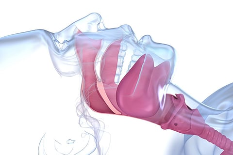sleep apnea