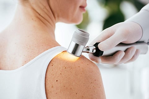 skin cancer melanoma