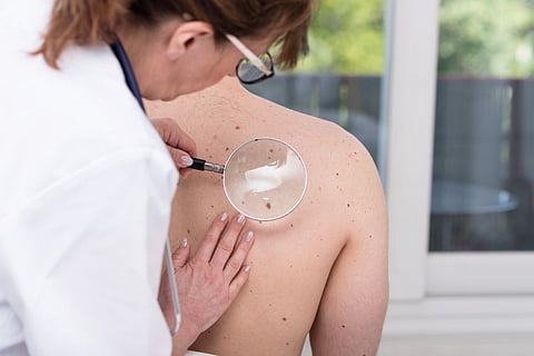 skin cancer melanoma