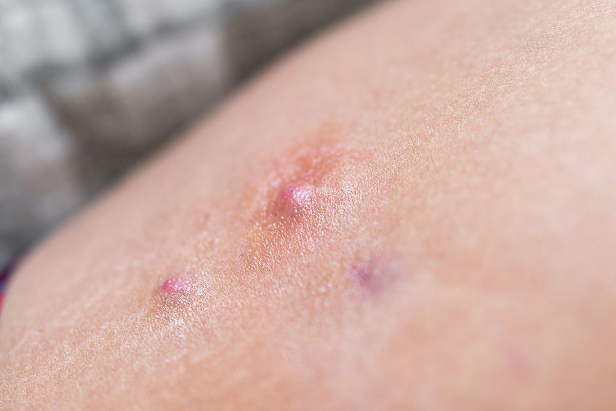 Hidradenitis Suppurativa Can Significantly Impair Sexual Health