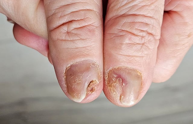N-NAIL Score More Accurate Than NAPSI for Diagnosing Nail Psoriasis