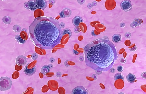 acute myeloid leukemia