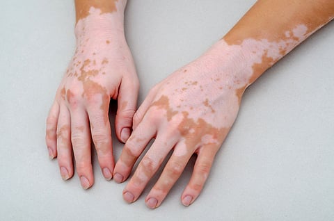 vitiligo on hands