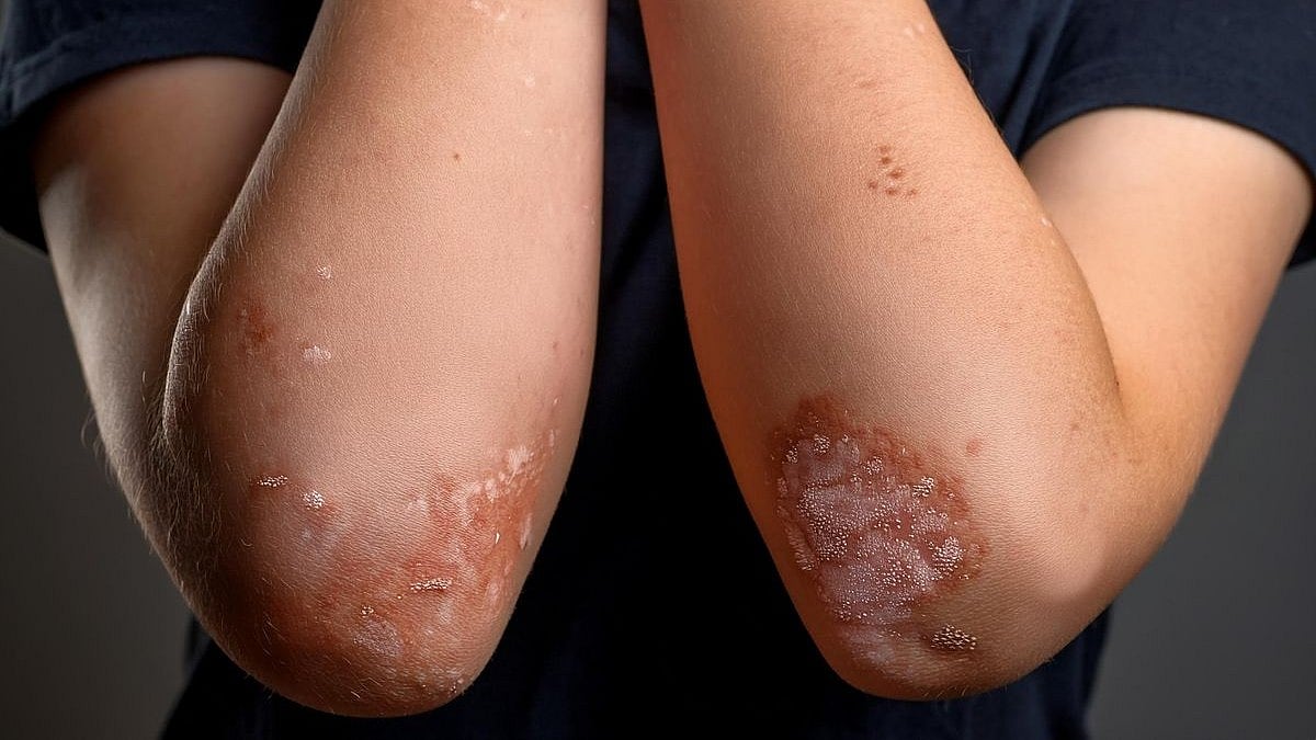 Predictive Model Shows Moderate Performance for Psoriasis Relapse Risk