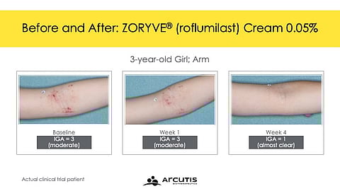 FDA Approves Zoryve for Atopic Dermatitis in Young Children