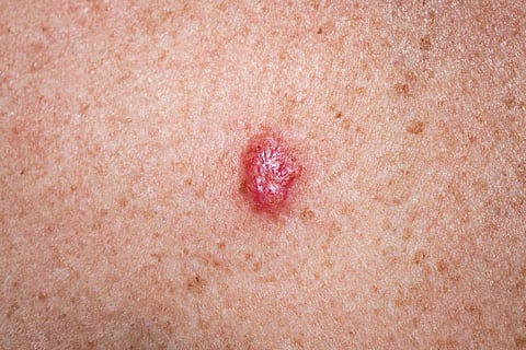 basal cell carcinoma