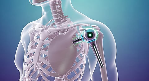 Shoulder replacement illustration showing metallic implant in human skeleton