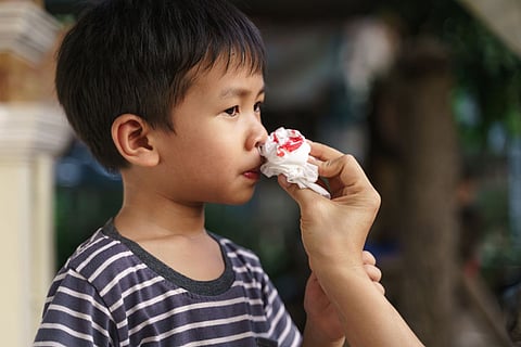 nose bleed child