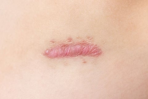 keloid scar