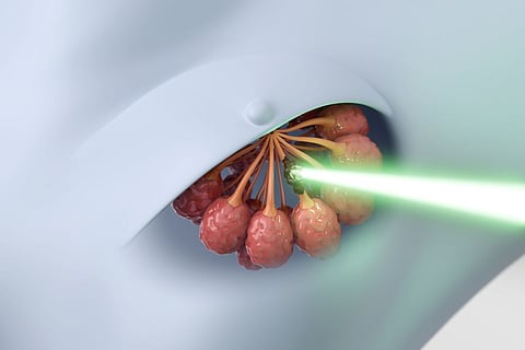 radiation breast cancer