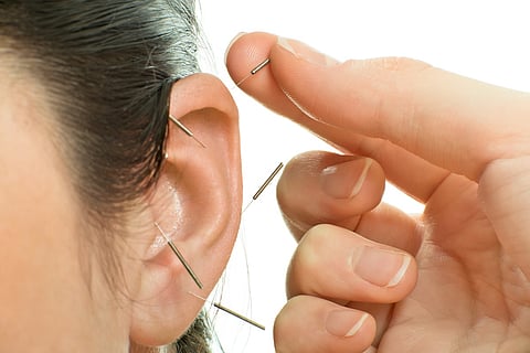 Acupuncture in the ear, acupuncture for pain