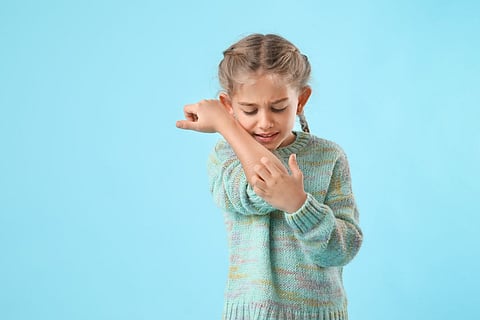 eczema atopic dermatitis