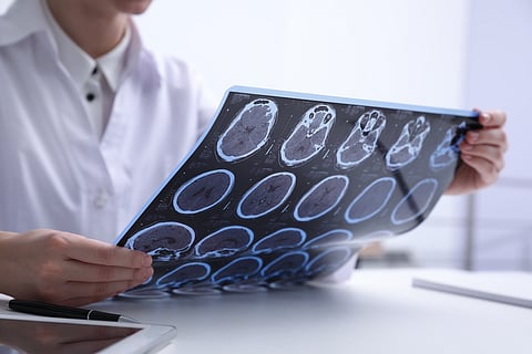 Doctor examines MRI scan of MS patient.