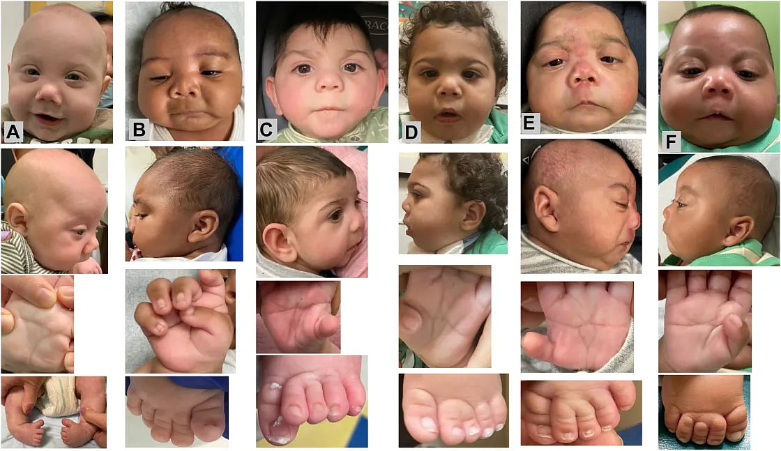 New Syndrome May Be Affecting Babies Exposed to Fentanyl
