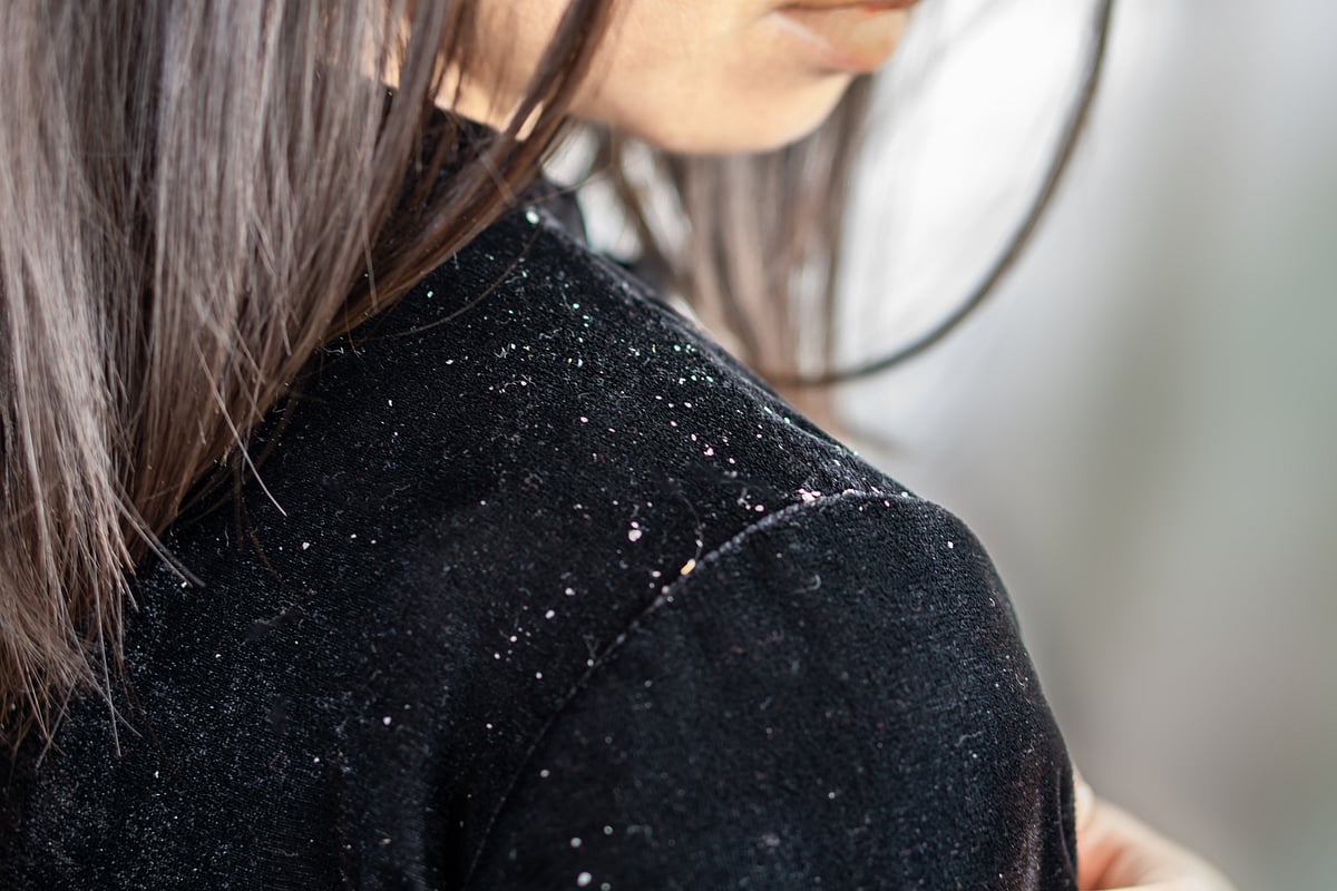 What Is Dandruff & How Is It Treated?