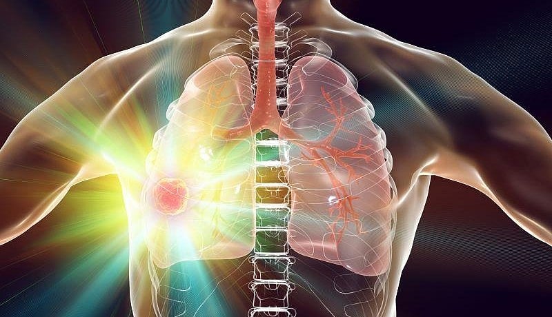 Adjuvant Alectinib Improves Disease-Free Survival in Lung Cancer