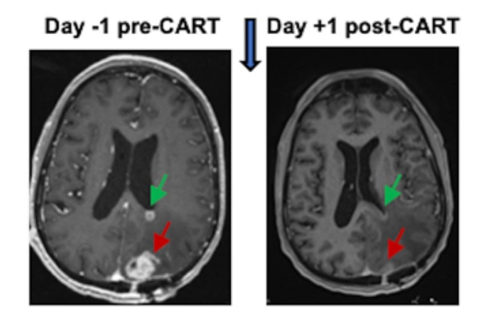 New Immune-Focused Therapy Shrinks Aggressive Brain Tumors