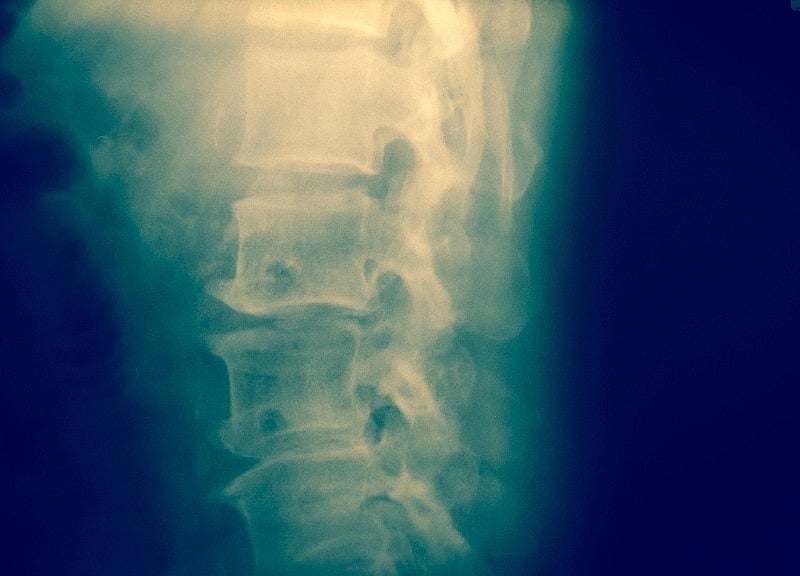 Spinal Cord 'Wraparound' Device Could Help Treat Paralysis