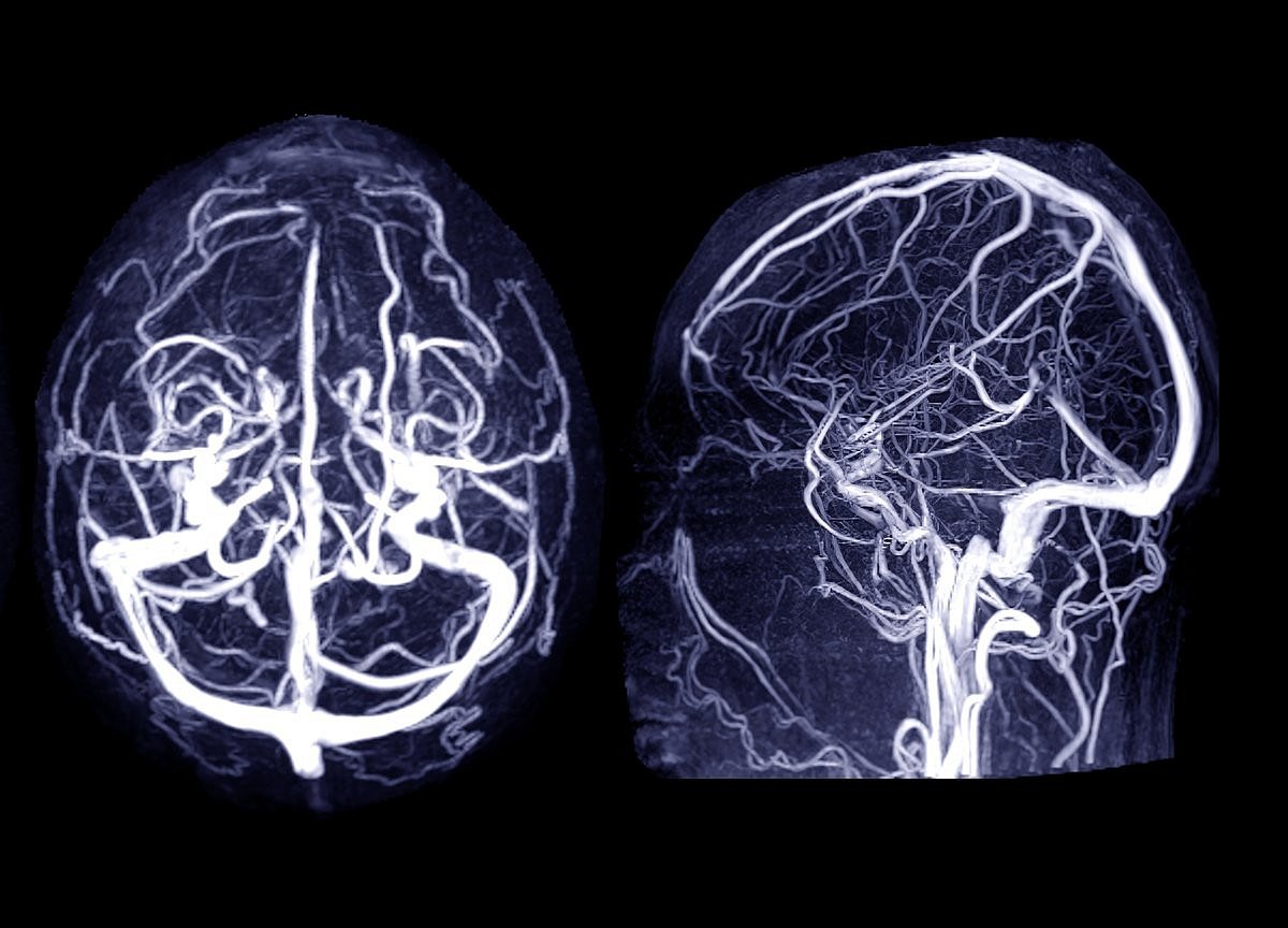 Statins, Metformin Can Cut Odds for Brain Aneurysms