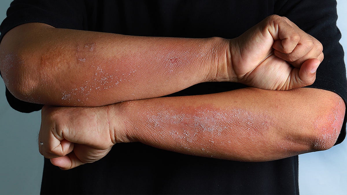 Bio Salt Itching Rash Too Much Salt in Your Diet May Lead to Eczema