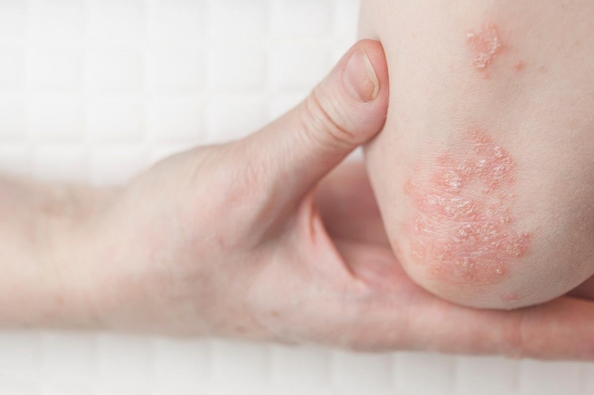 Autoimmune Diseases Like Lupus, Psoriasis May Raise Cancer Risk