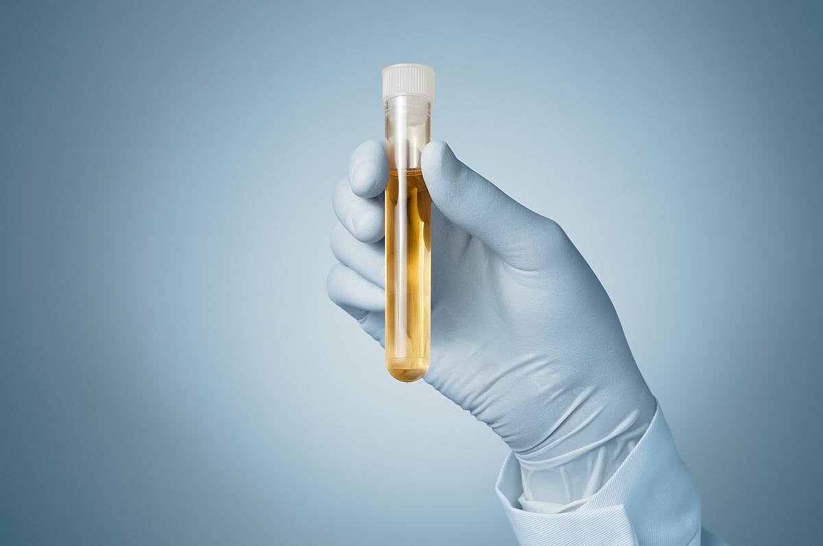 Urine Test Can Detect Autism, Study Says